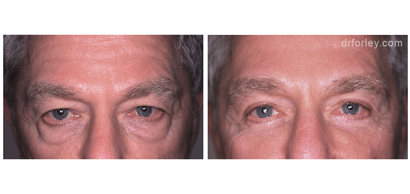 Male face, before and after upper and lower eyelid surgery, front view, patient 1