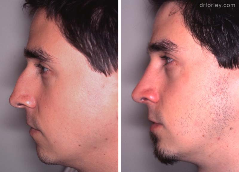 Male face, before and after open rhinoplasty treatment, side view, patient 3