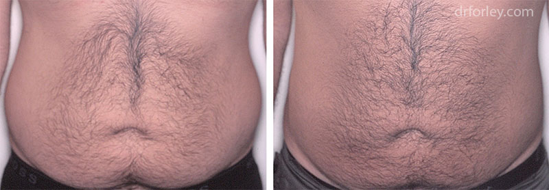 Male body, before and after liposuction treatment, front view, patient 5