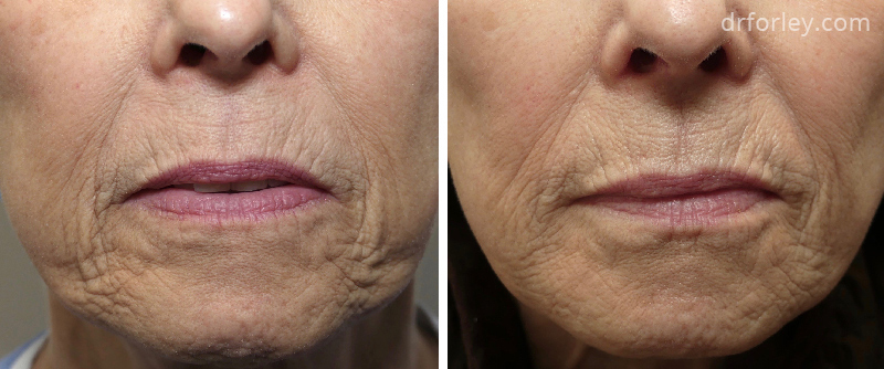 Female lips, before and after Injectable Fillers treatment, front view, patient 7